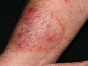 Tinea Corporis Fungal Infection Mycosis Foto stock 792740977