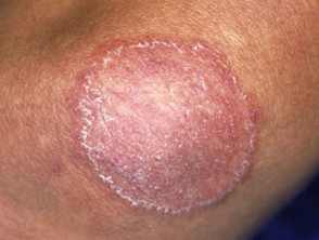 Tinea corporis: ringworm lesion on skin - Stock Image - M270/0169 - Science  Photo Library