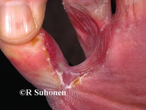 Close-up of athlete's foot Tinea pedis infection - Stock Image - M270/0145  - Science Photo Library