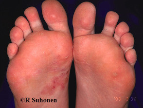 Close-up of athlete's foot (tinea pedis) infection - Stock Image -  M270/0161 - Science Photo Library
