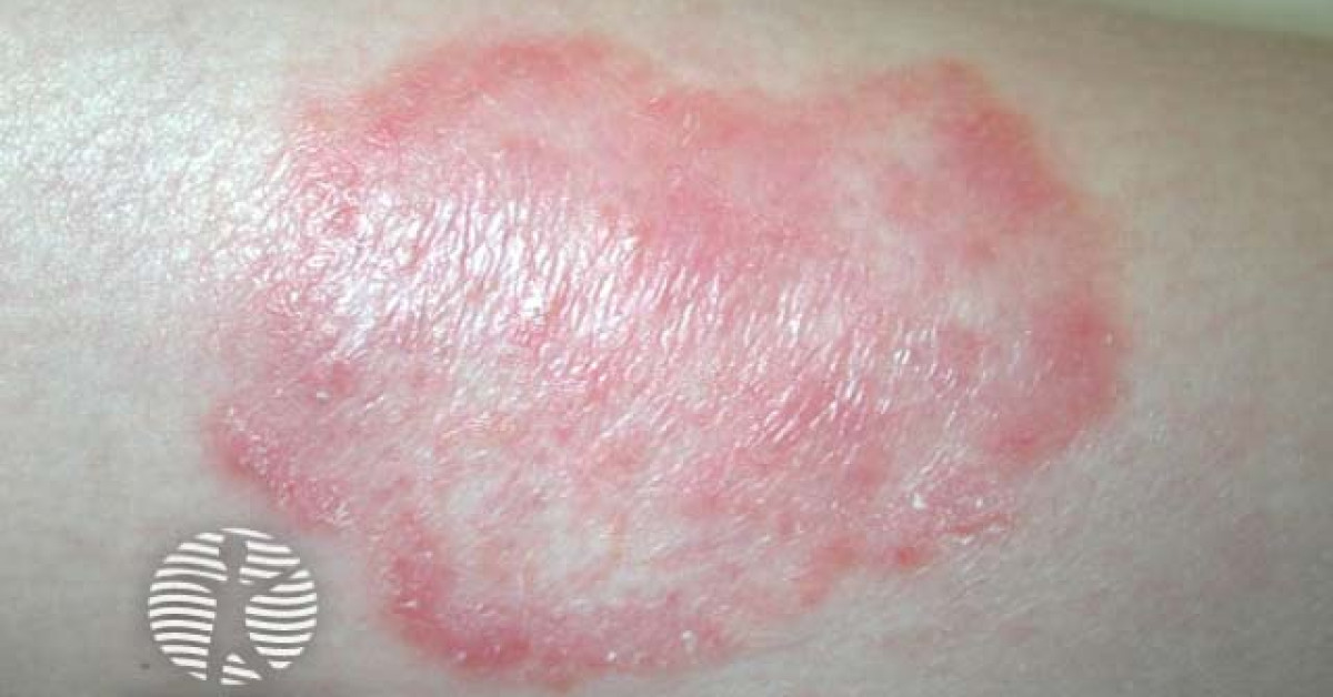 DermNet® - Tinea corporis image