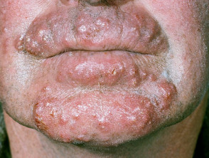 Dermatomycosis barbae, AKA fungal neckbearditis. [Warning: gross] : r/WTF