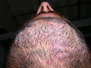 Tinea barbae (fungal infection of the beard) | DermNet