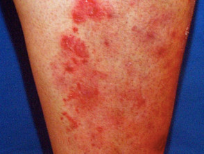 Tinea incognita due to application of topical steroid to fungal infection