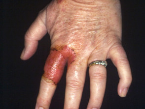 Fungal infection on a man's hand, illustration. Known as ringworm  infection, or tinea manuum. It can be caused by various fungi, including  Trichophyton mentagrophytes. It causes severe itching. The disease is highly