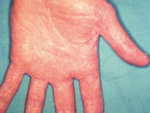 Tinea Manuum (Fungus in the Hands)