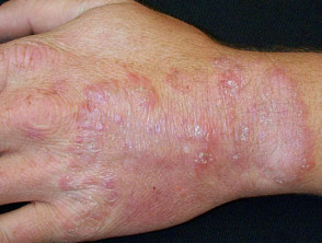 Tinea manuum is a fungal infection of the hands. Tinea causes a red, scaly  rash that usually has a border that is slightly raised. Th