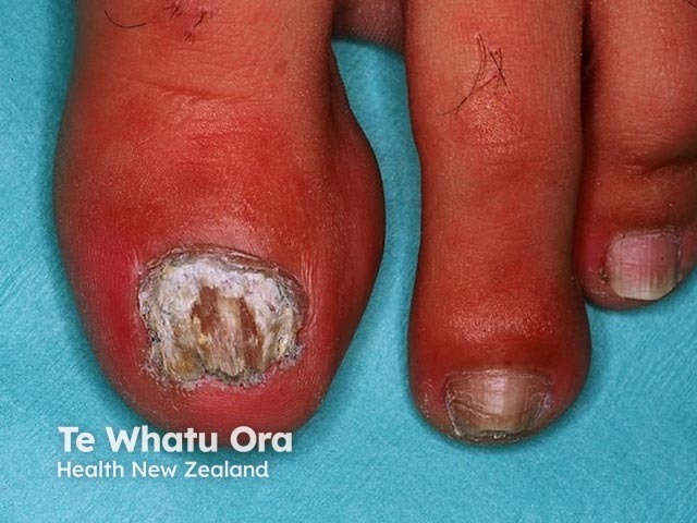 Fusarium infection of the toenail