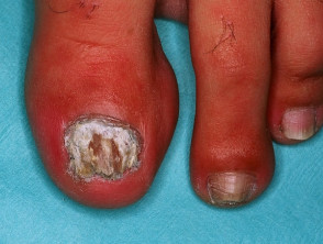 Fusarium infection of the toenail