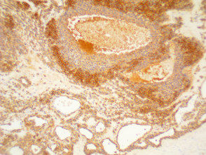 Glomus tumour pathology stained with SMA  x100