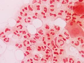Gonococcus Gram stain