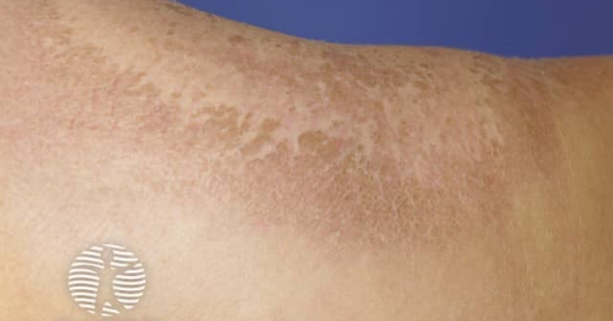 Granular parakeratosis image