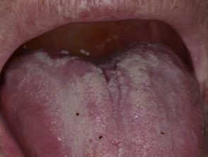 Mouth ulceration + glossitis in granulomatosis with polyangiiitis 