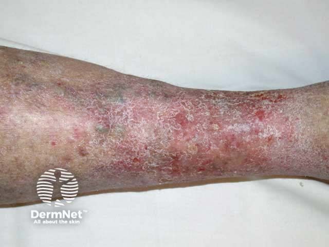 Venous eczema, lower leg