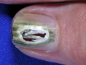 Green nail due to pseudomonas infection