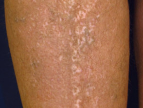 Guttate vitiligo