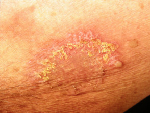 Hailey-Hailey disease blisters