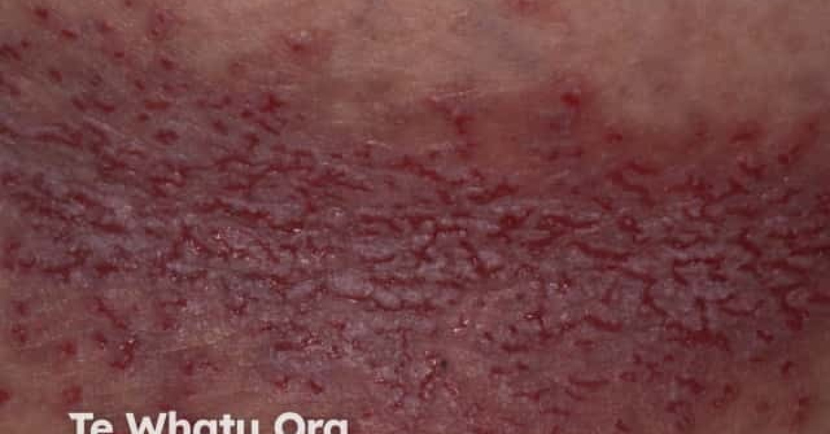 Hailey Hailey disease close up image