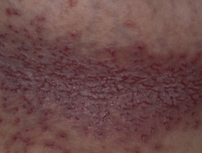 Hailey Hailey disease close up