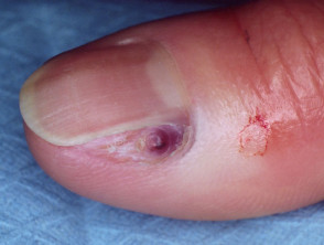 Melanoma of nail unit