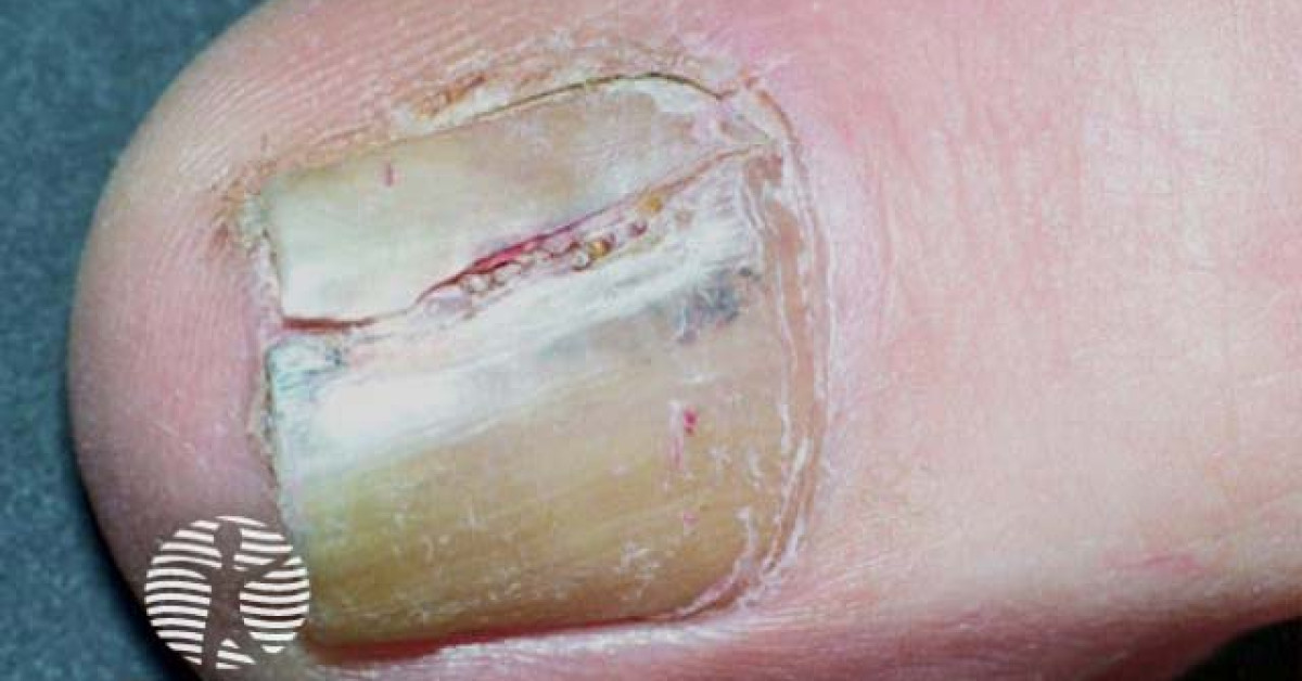 DermNet® - Melanoma of nail unit image