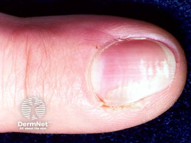 Bowen disease of nail