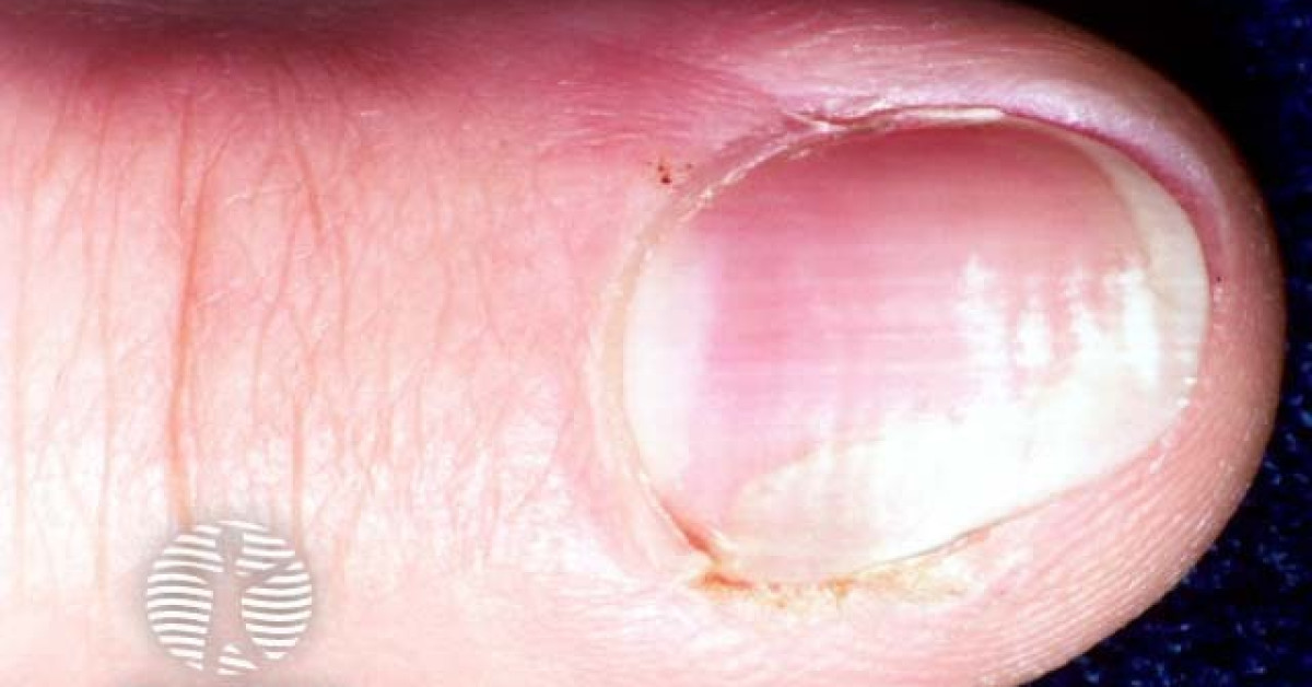 Bowen disease of nail image