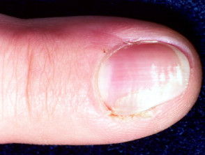 Bowen disease of nail