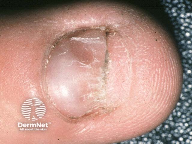 Giant cell tumour of tendon sheath