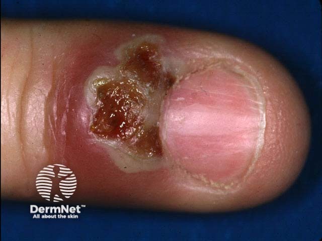 Clustered vesicles, due to HSV, have broken down into erosions on the proximal nail fold