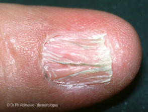 Lichen planus of nail