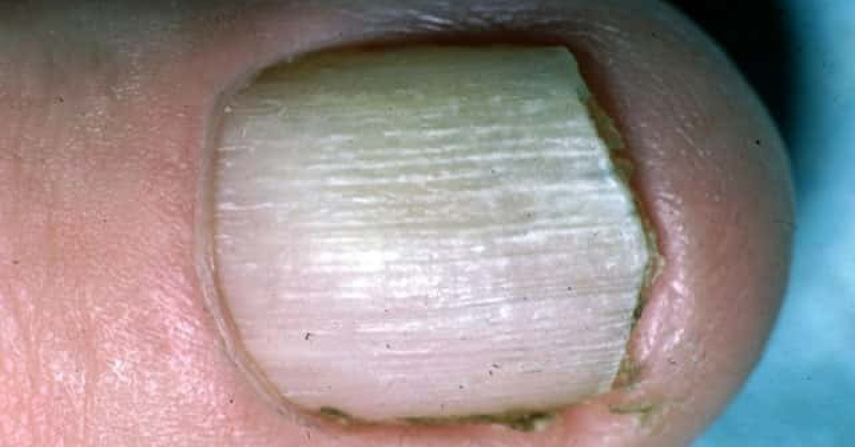 DermNet® - Lichen planus of nail image