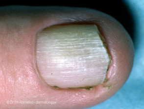 Lichen planus of nail