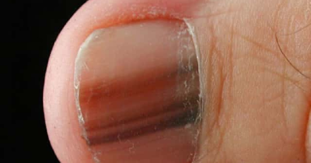 Melanoma of nail unit image