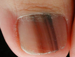Melanoma of nail unit