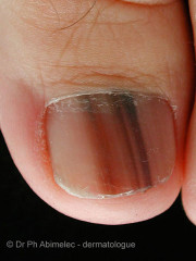 Nail melanoma