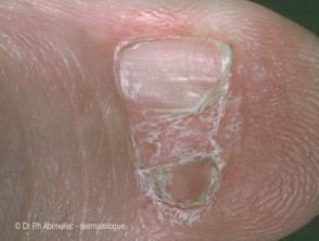 Nail dystrophy in nail patella syndrome 