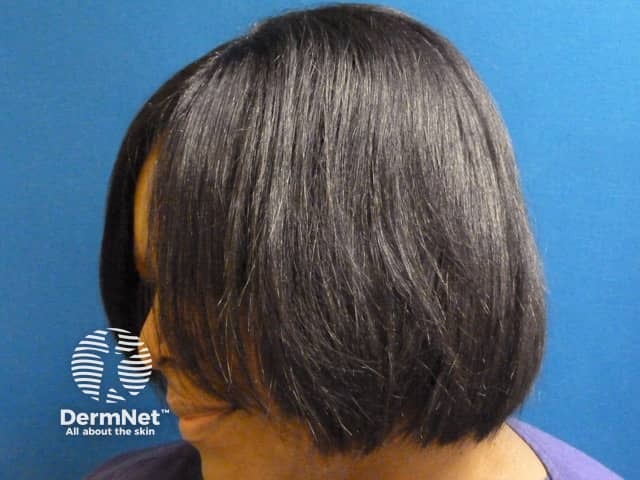 Relaxer used to straighten hair in woman of African descent