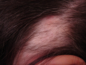 Alopecia areata