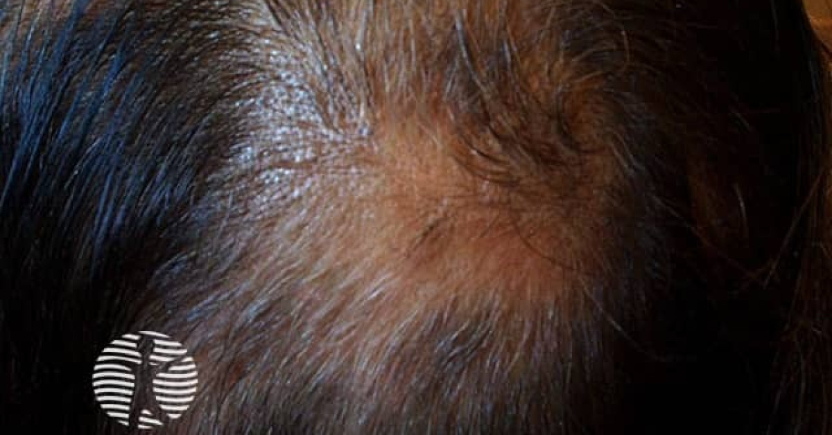 Alopecia areata image