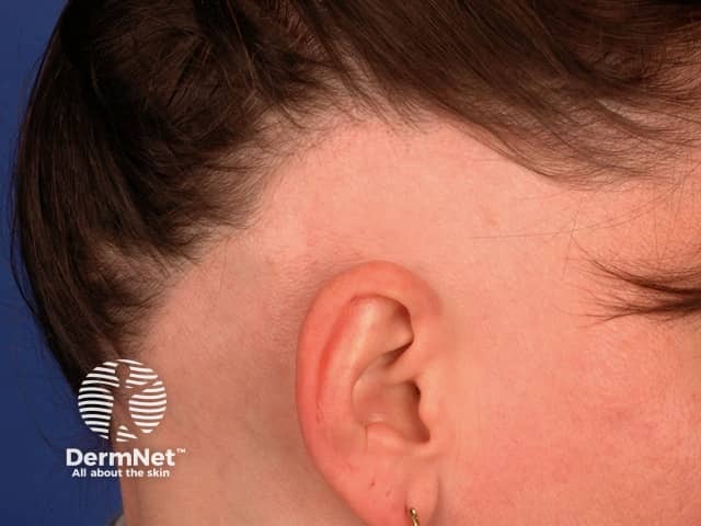 Ophiasis pattern of alopecia areata