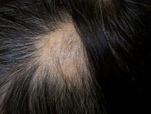 Riverside Dermatology & Spa - Alopecia (al-oh-PEE-shah) means hair loss.  When a person has a medical condition called Alopecia areata  (ar-ee-AH-tah), the hair falls out in round patches. The hair can fall