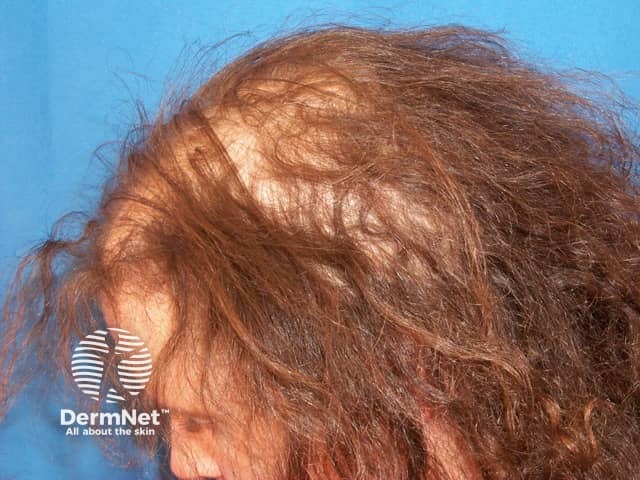 Anagen effluvium: alopecia areata