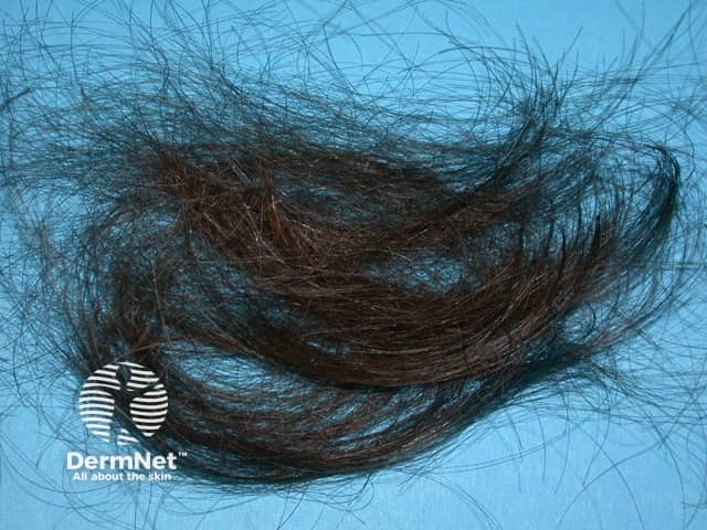 Anagen effluvium: hair pull