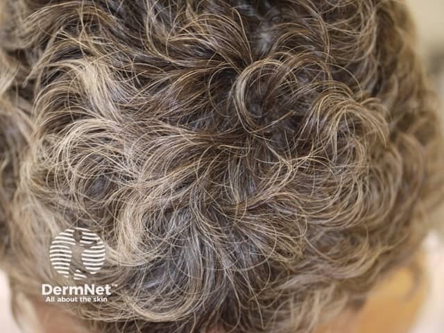 Anagen effluvium: regrowth after chemotherapy with curly hair