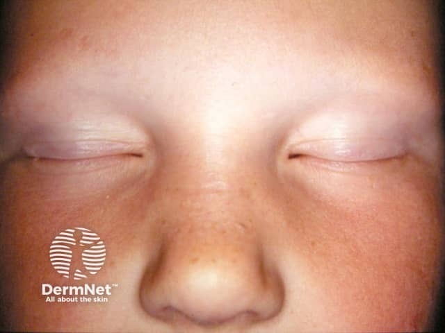 Anagen effluvium: loss of eyelashes in alopecia areata