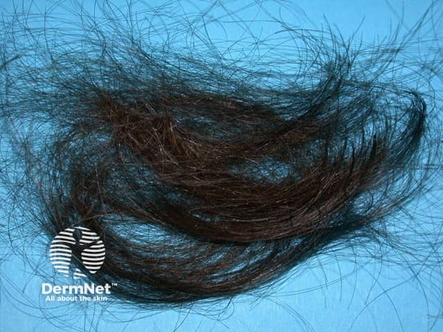 Hair lost through chemotherapy