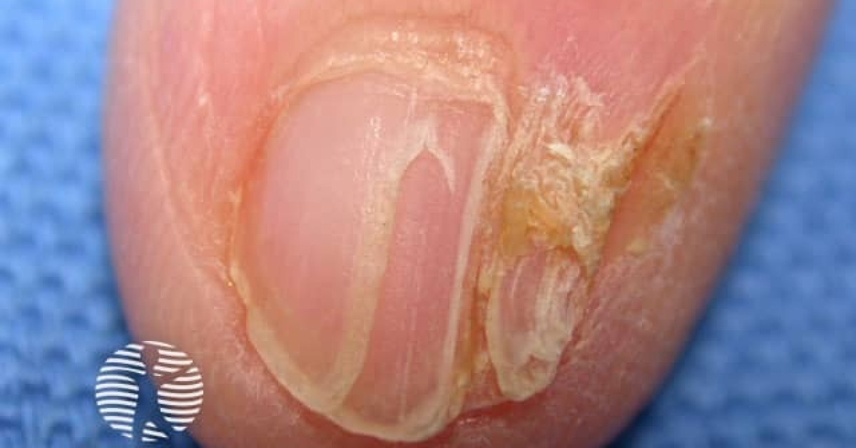 Pterygium of nail due to lichen planus image