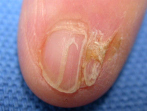Pterygium of nail due to lichen planus