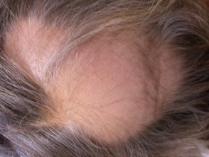 Define alopecia